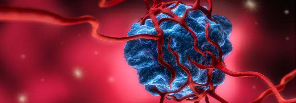 JAK-Resistenzen bei myeloproliferativen Neoplasien: Überlebende Klone angreifbar
