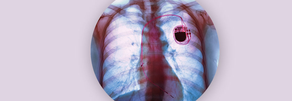 Schwere Reflexsynkopen: Sind Kipptisch und Closed-Loop-Stimulation die Lösung? Ein Zwei-Kammer-Schrittmacher mit Closed-Loop-Stimulation greift ein, bevor der Patient kollabiert.