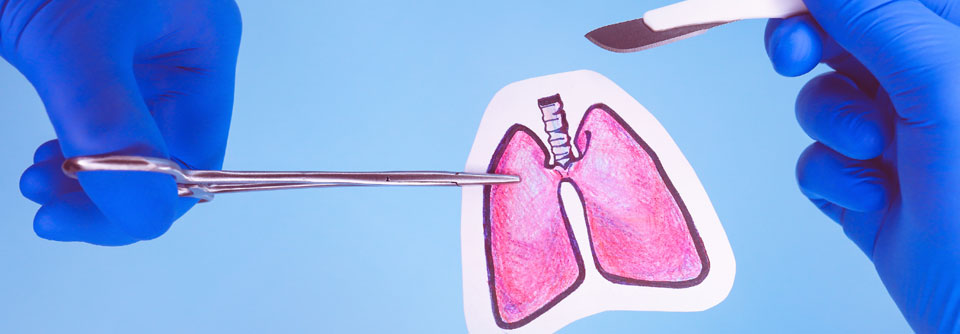 Im Fall der 61-jährigen COPD-Patientin wurde die Spenderlunge als transplantierfähig befunden.