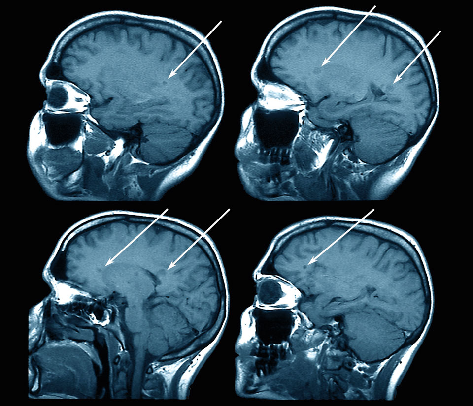 Farbige Magnetresonanztomographie (MRT)-Aufnahmen eines Patienten mit Multipler Sklerose (MS).