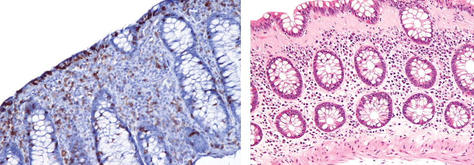 Lymphozytäre Kolitis (links) mit vielen T-Zellen (braun) im Epithel und der Lamina propria. Die Krypten sind intakt, aber das Oberflächenepithel dünn und ohne Schleim. Typisch für die kollagenöse Form (rechts) ist ein verdicktes subepitheliales Kollagenband.