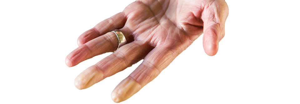 Abblassende Finger können Hinweis auf eine beginnende Sklerodermie sein.