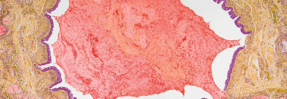 Histologischer Schnitt durch Lungengewebe eines Asthmatikers: Das Lumen einer Bronchiole ist durch Mukus verlegt, die Basalmembran erscheint verdickt.