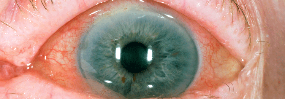 Deutlich gerötete Augen, Schleiersehen und Schmerzen sind Symptome einer akuten vorderen Uveitis.
