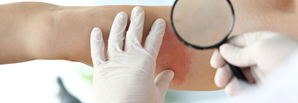 Chronisch spontane Urtikaria mit 7C diagnostizieren