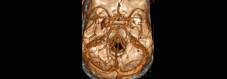 Zerebrale Vaskulitis mit teils verengten, teils erweiterten Gefäßabschnitten (rekonstruierte 3D-Angiographie).