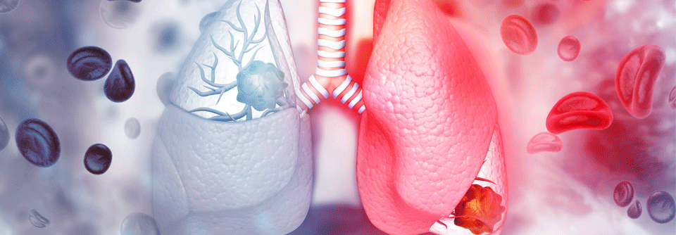 Tochtergeschwülste bilden sich beim NSCLC vor allem in der kontralateralen Lungenhälfte, dem Gehirn und den Nebennieren aus.