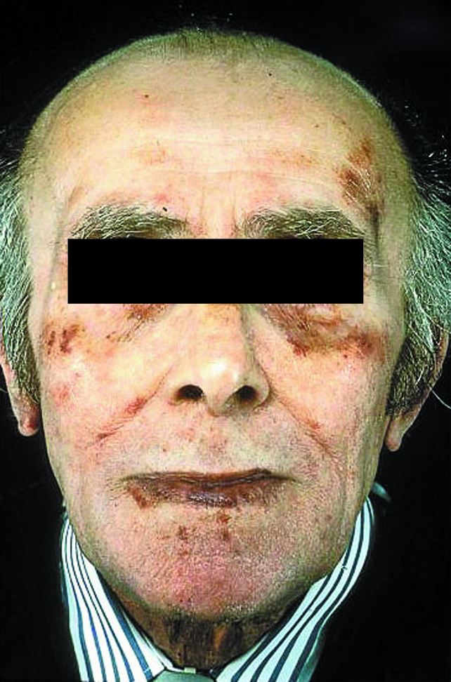Die periorbitale Purpura ist typisch für eine Leichtketten-Amyloidose.