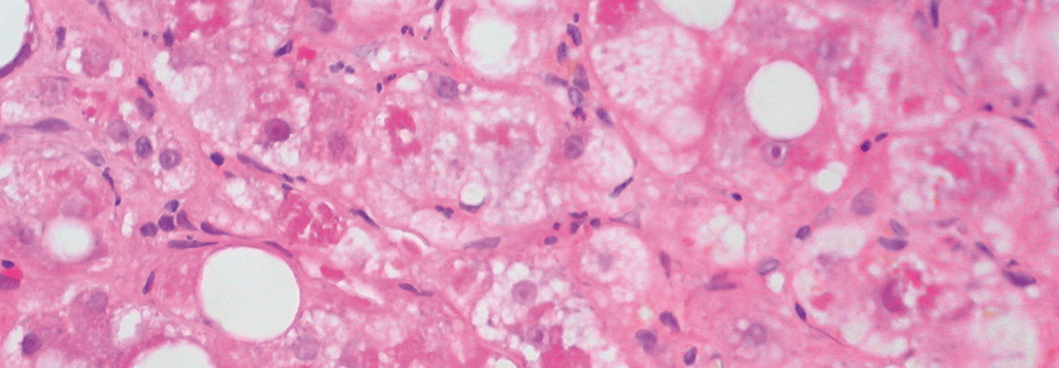 Entgleiste Leberzirrhose: Durchbruch in der Pharmakotherapie bleibt aus