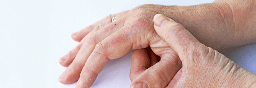 Patientinnen und Patienten mit Psoriasisarthritis sind unterversorgt.