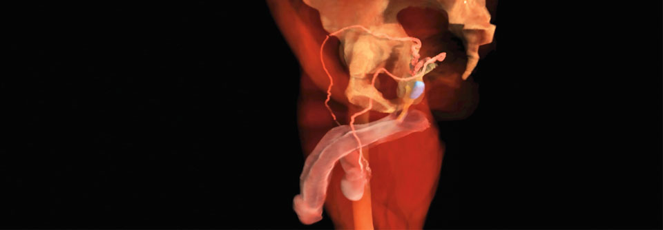 PARP-Hemmer eignen sich beim BRCA-Prostatakrebs am besten