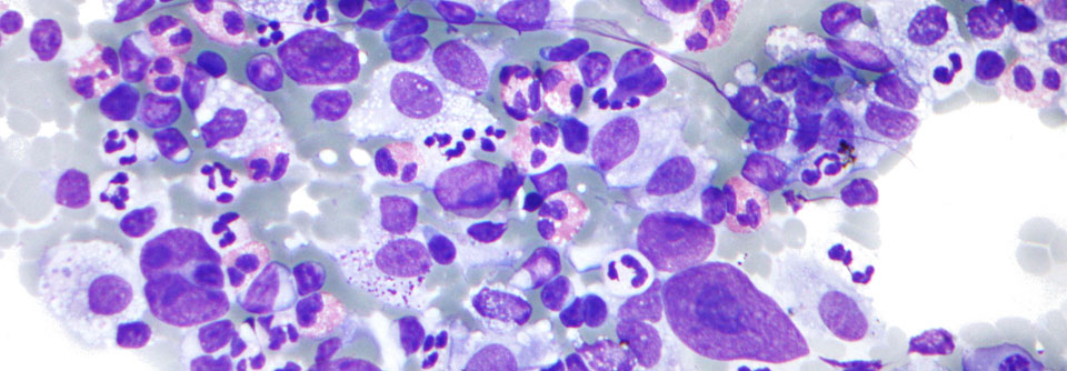 Wäre das Hodgkin Lymphom in einem early favorable Stadium, umfasst der Standard eine 2+2 Chemotherapie, ergänzt durch eine Bestrahlung.