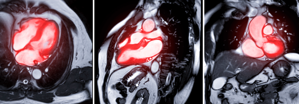 Bereits in frühen Stadien einer Erkrankung liefert das Kardio-MRT zuverlässige Daten für die Diagnostik.