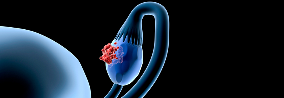 Die Resistenzen gegen PARP-Inhibitoren sollten der Therapie nicht mehr im Weg stehen.