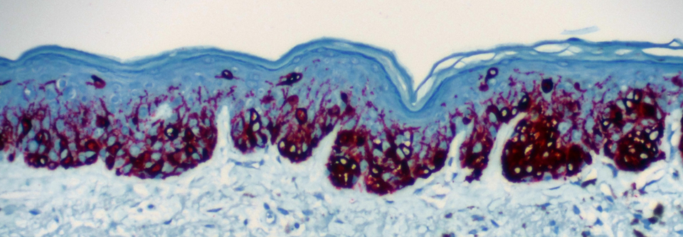 Unter dualer Immuntherapie lebte nach 6,5 Jahren noch knapp die Hälfte der Studienteilnehmer mit metastasiertem Melanom.