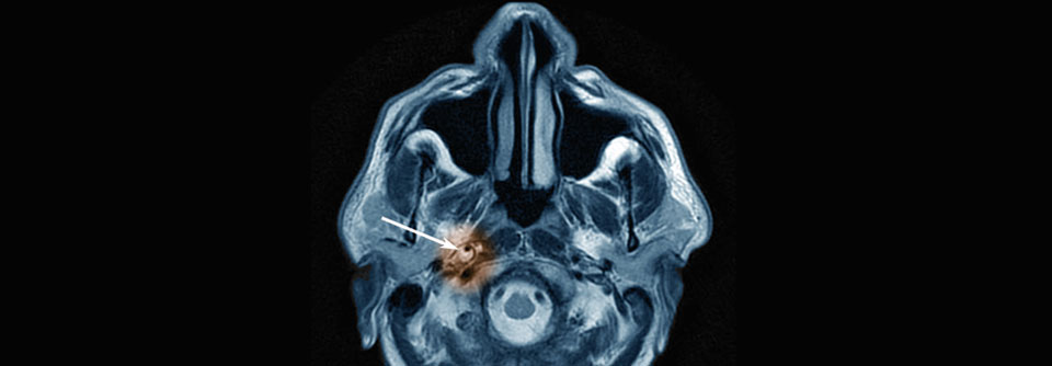 Schlaganfall nach Dissektion der A. carotis interna in der rechten Hemisphäre.