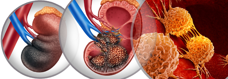 Pembrolizumabhaltige Erstlinien überzeugen im Langzeitverlauf gegen das fortgeschrittene klarzellige Nierenzellkarzinom (RCC). 