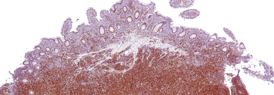 Vorläufige Daten zur Kombination von Rituximab, Lenalidomid und Venetoclax beim Mantelzell-Lymphom vorgestellt.