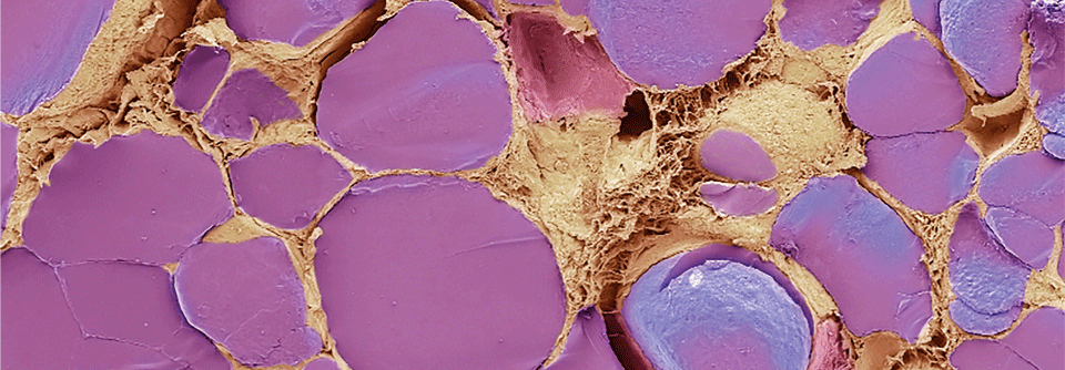 Die Schilddrüse sezerniert Thyroxin und Trijodthyronin vom Epithel in die Speicherkammern (violett).