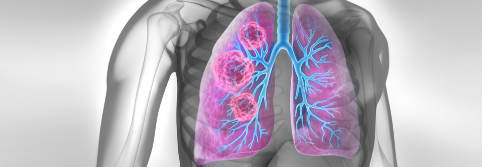 Auf Basis der Studie CodeBreak100 erhielt Sotorasib eine beschleunigte FDA-Zulassung für das KRAS G12C-mutierte NSCLC.