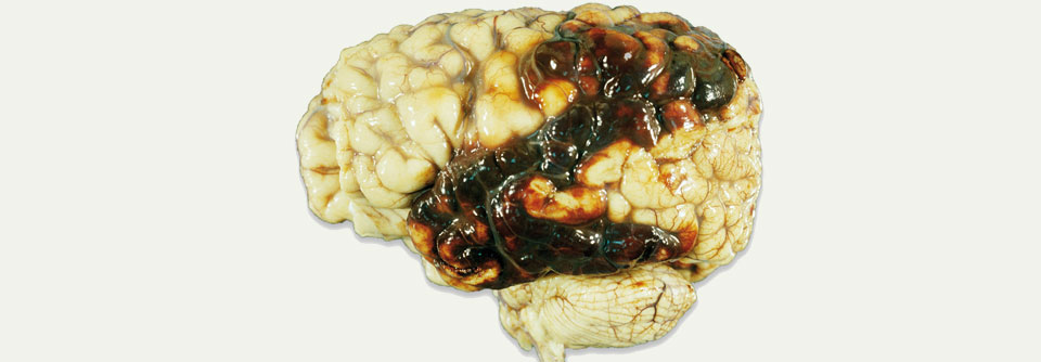 Hirnblutungen unter NOAK verlaufen in rund jedem vierten Fall tödlich.