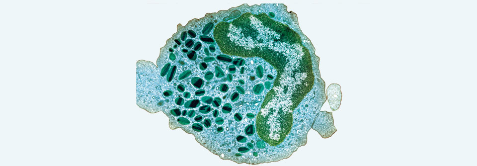 Polypen und visköser Erguss – eosinophile Otitis richtig erkennen Mitunter halten eosinophile Granulozyten die Hörschnecke für einen Parasiten.