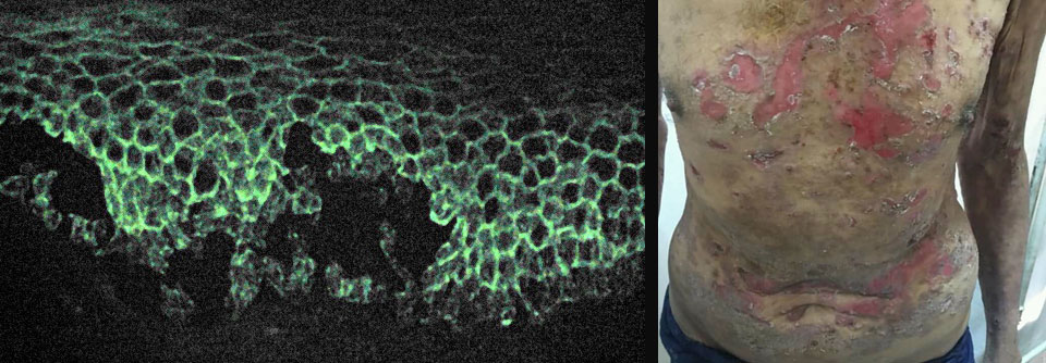 Unterm Mikroskop betrachtet hat die Erkrankung durchaus etwas Schönes an sich (links). In der Realität sieht der Pemphigus vulgaris aber deutlich schlimmer aus (rechts).
