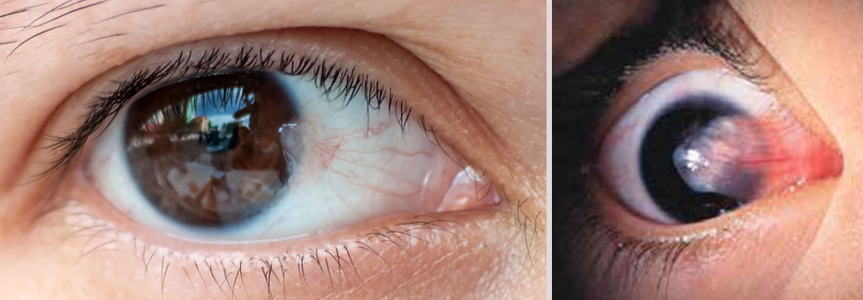 Schließt das Pterygium die optische Achse mit ein, kann das auch die Sicht stören.