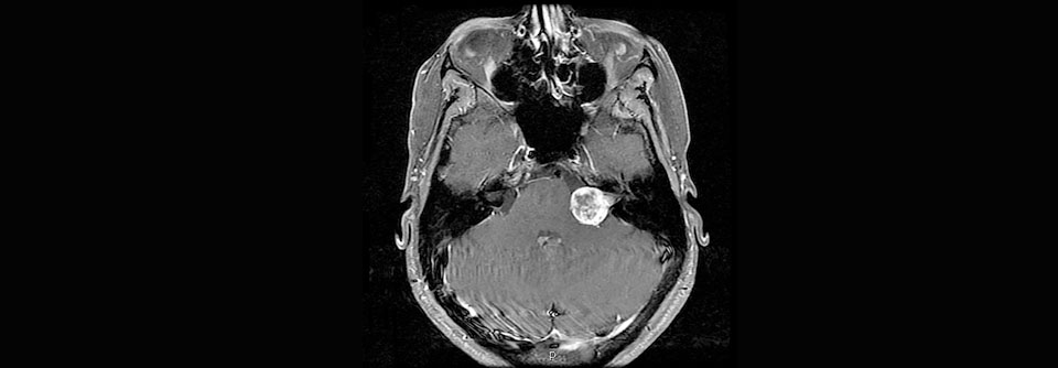 In der MRT stellt sich ein kontrastmittelaufnehmendes vestibuläres Schwannom dar. 