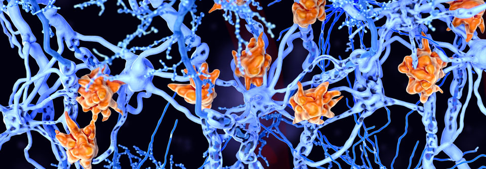 Bei der MS greifen Mikrogliazellen (orange) die Oligodendrozyten an.