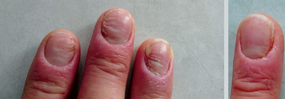 Seit ca. 1,5 Jahren klagt ein Computerspezialist über entzündlich-eitrige Läsionen an manchen Fingerendgliedern.