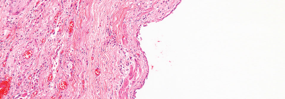 Die Zunahme von Bindegewebe in der Lunge verringert die Dehnbarkeit des Organs. Forscher haben einen Therapieansatz gefunden, um diesen Prozess aufzuhalten.