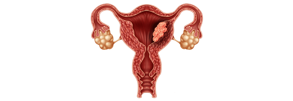 Endometriumkrebs tritt häufig nach Ende der Wechseljahre auf.