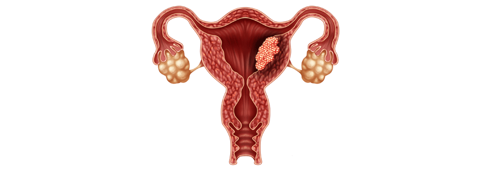 Erste Immuntherapie bei Endometriumkrebs Endometriumkrebs tritt häufig nach Ende der Wechseljahre auf.