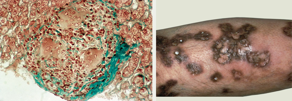 Die Sarkoidose kann unterschiedlichste Regionen des Körpers betreffen. So zum Beispiel die Haut (rechts) oder auch die Leber (links).