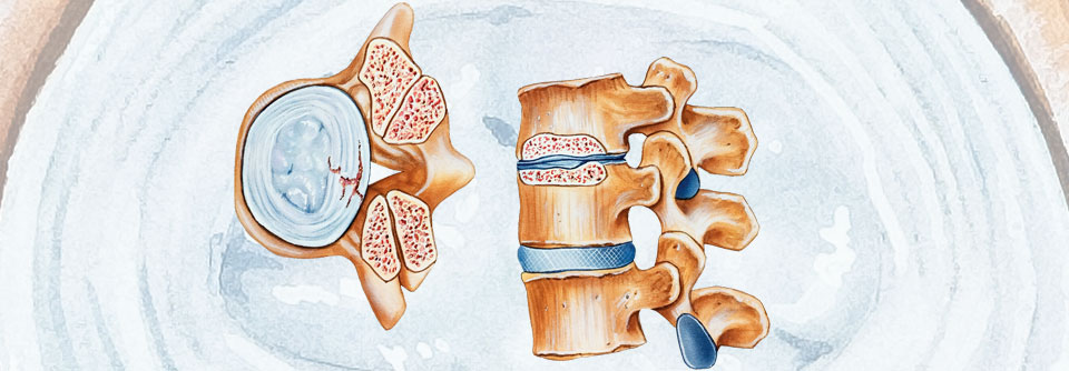 Durch degenerative Prozesse verengt sich der Spinalkanal. Dies kann zu einer Kompression von Nerven und Gefäßen führen.