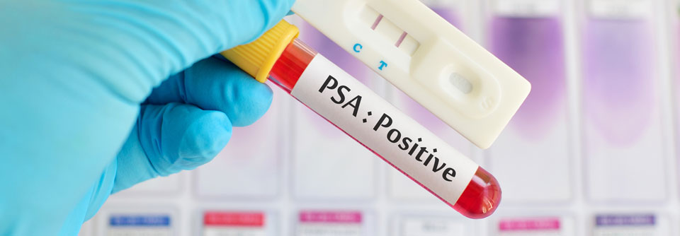 Wenn in der Familie gehäuft Prostatakarzinome auftreten, sollte schon früher mit einem regelmäßigen PSA-Screening begonnen werden.