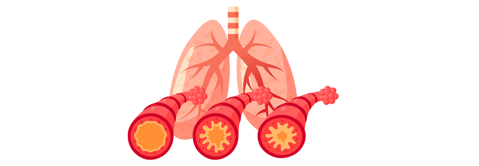 Das Biologikum zur Behandlung von Asthma kann auch vom Patienten selbst injiziert werden – was die Therapietreue fördert.