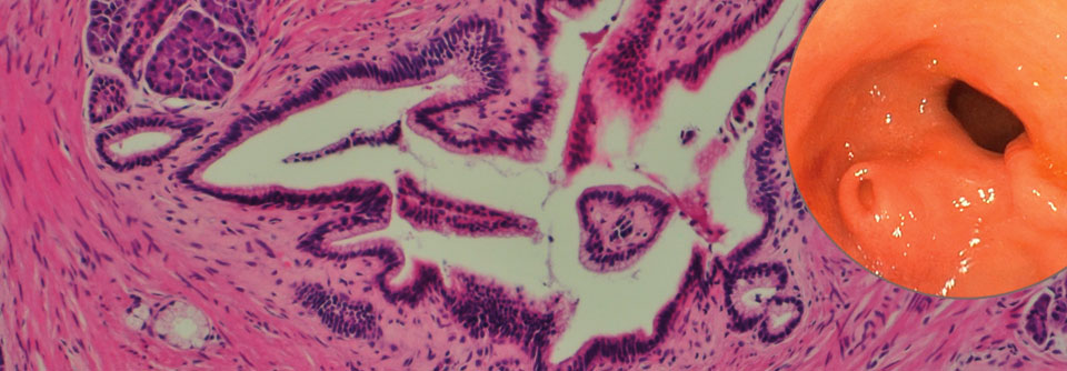 In der kraterförmigen Magenwandverdickung nahe des Pylorus (rechts) fand man lobuliertes Pankreasgewebe (links). 