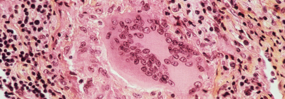 Lymphknoten mit typischem Sarkoidosegranulom (lichtmikro­skopische Aufnahme in HE-Färbung).