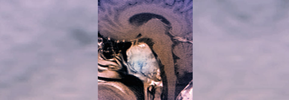 Bei diesem Patienten mit Erdheim-Chester-Disease findet sich eine Knochenbeteiligung an der Schädelbasis: Osteosklerosen und Knochenerosionen deutlich zu erkennen. 