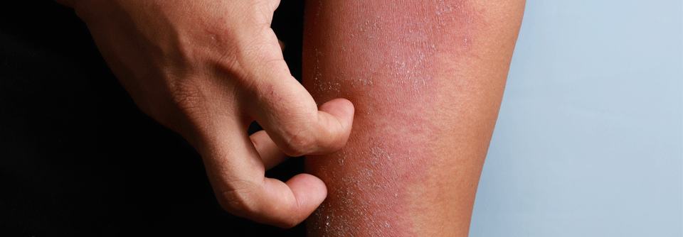 Der Teufelskreis aus Juckreiz und Kratzen muss unterbrochen werden, um schmerzhafte Entzündungen der Haut zu verhindern.