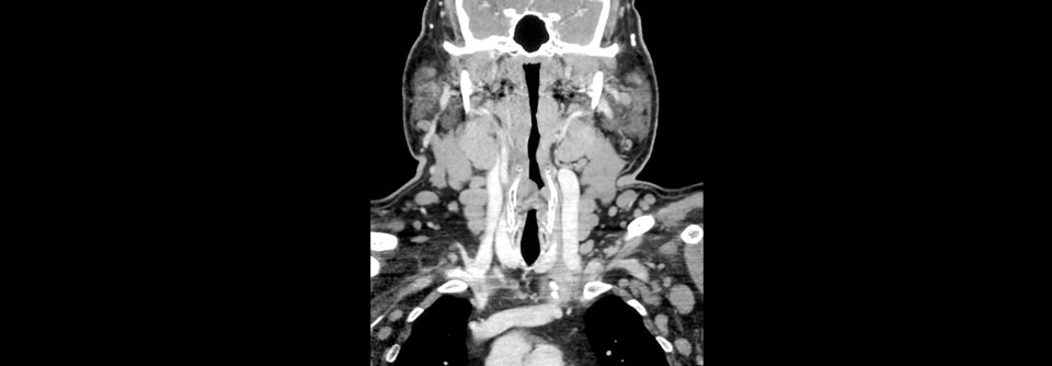 Ein typisches Bild bei CLL: Viele Lymphknoten in Hals und Axilla sind vergrößert. 