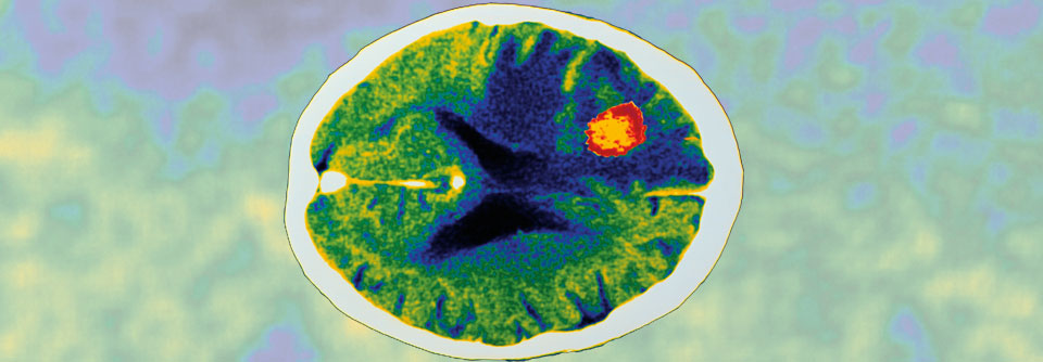 Bei AIDS-Patienten mit Hirnabszess ist auch an eine Infektion mit Toxoplasma zu denken.