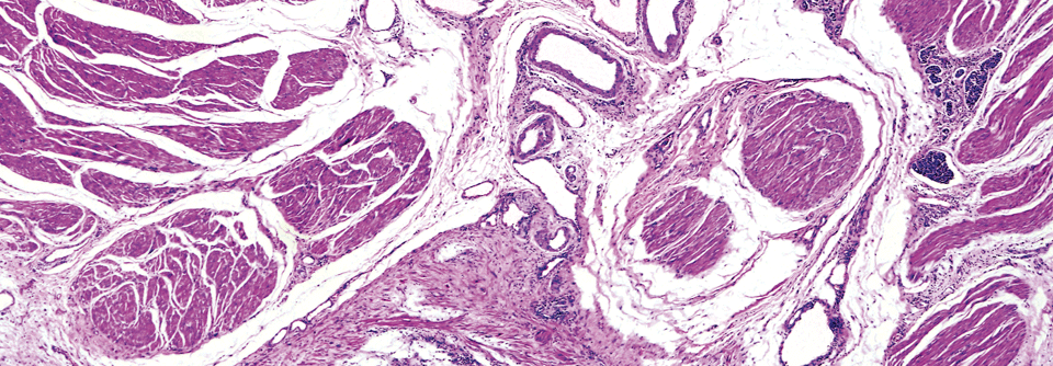 Lichtmikroskopische Aufnahme eines Urotheltumors der Blase. Dies ist die am häufigsten auftretende Form von Harnblasenkrebs. Wesentlich seltener sind Plattenepithel- und Adenokarzinome.