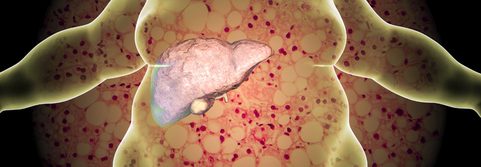 Die Fettleber ist nicht zu unterschätzen, denn mit ihr gehen auch einige weitere Erkrankungen einher.