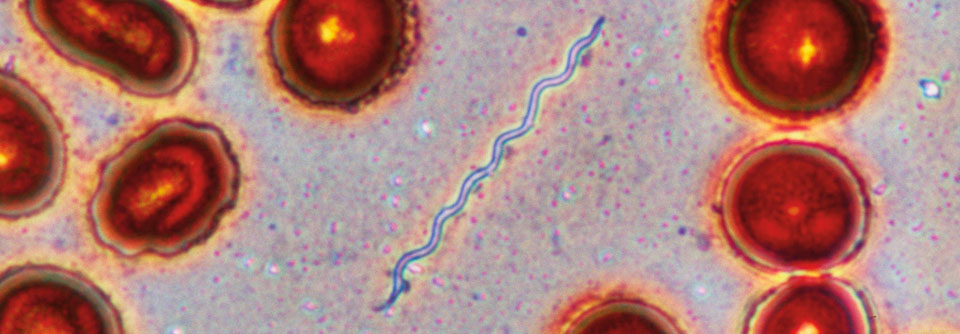 Eine systemische Borreliose lässt sich mit der intravenösen Gabe von Ceftriaxon gut in den Griff bekommen.