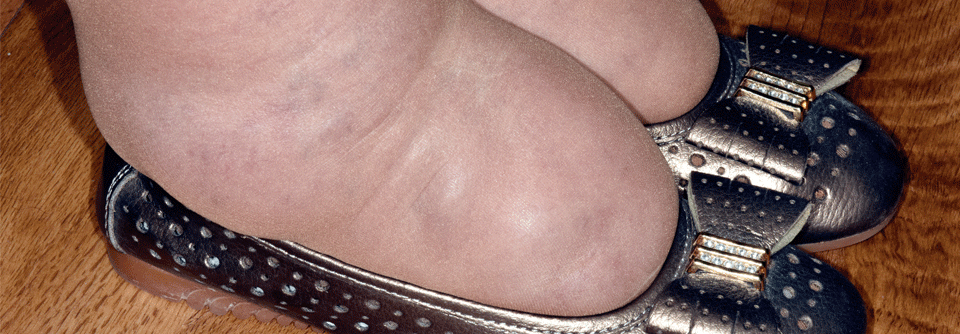 Ödeme am Knöchel sind besonders ausgeprägt, da die Bindegewebsschicht an dieser Stelle dünn ist. Gleiches gilt für das Schienbein.