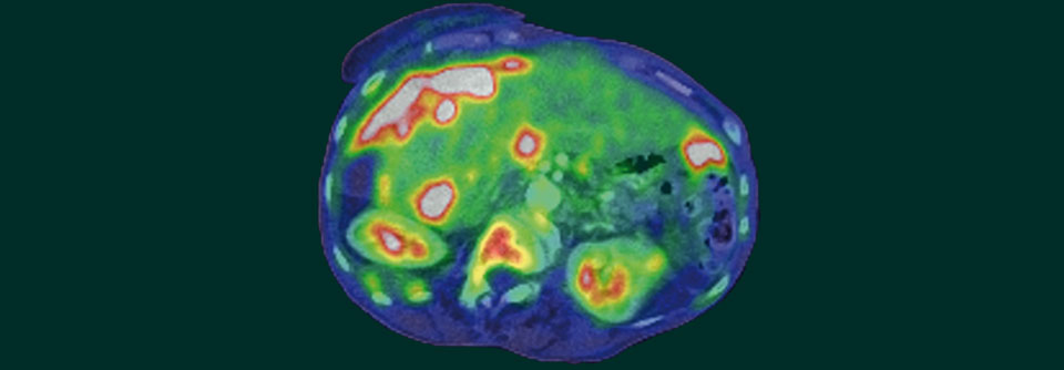 Ovarialkarzinome sind lange asymptomatisch, weshalb sie i.d.R. in späten Stadien diagnostiziert werden.