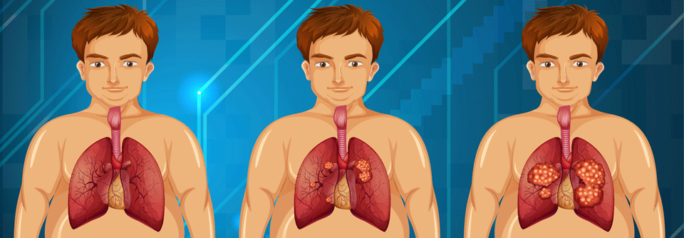 Wie sieht es mit Alternativen bei der zielgerichteten Therapie des ALK-positiven NSCLC aus?